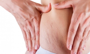 The Truth About Laser Stretch Mark Removal